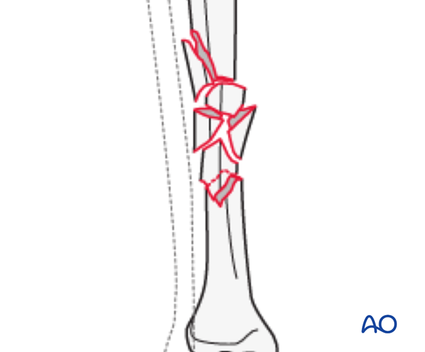 Multifragmentary fracture, fragmentary segmental (AO/OTA 42C3)