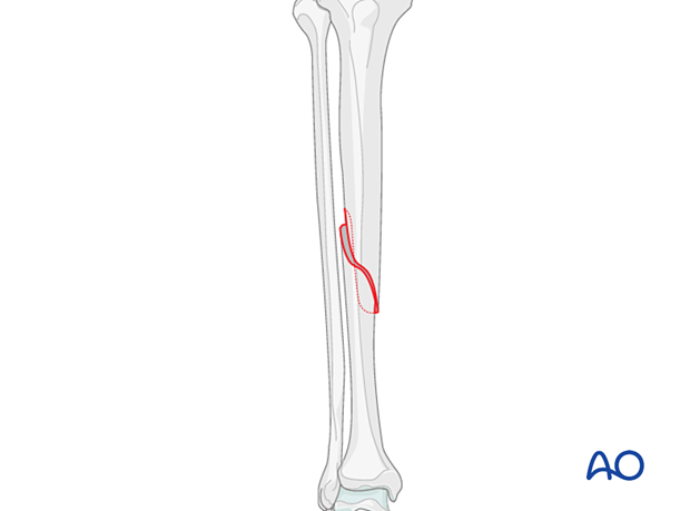 Simple fracture, spiral