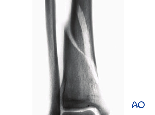 Simple fracture, spiral