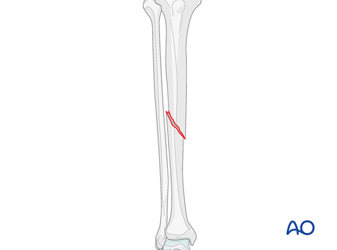 Simple oblique fracture
