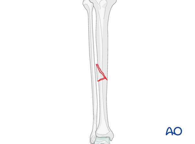 Wedge fracture, intact wedge