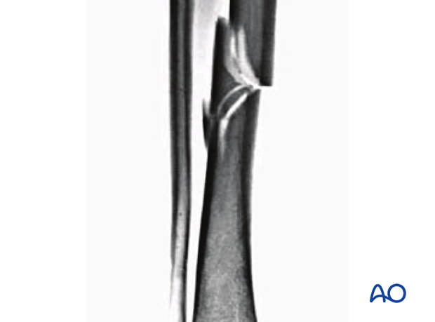 Wedge fracture, intact wedge