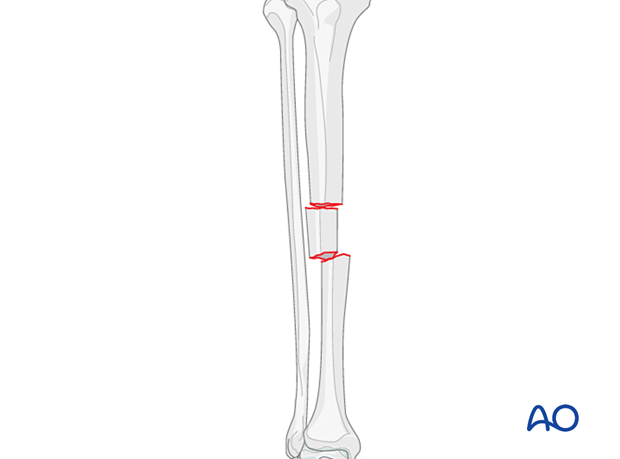 Multifragmentary fracture, intact segmental