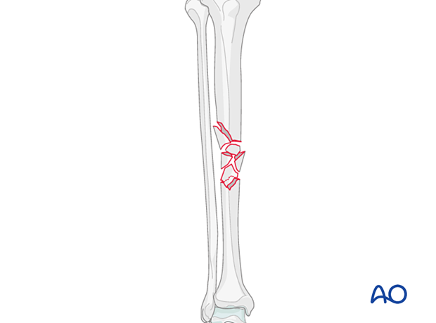 Multifragmentary fracture, fragmentary segmental (AO/OTA 42C3)