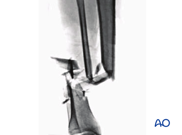 Multifragmentary fracture, fragmentary segmental