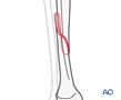 tibial shaft