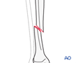 tibial shaft