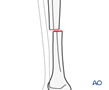 tibial shaft