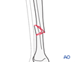 tibial shaft
