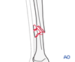 tibial shaft