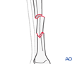 tibial shaft