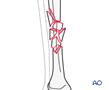 tibial shaft