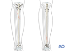 Tibial shaft simple spiral fracture: intramedullary nailing