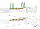 Tibial shaft simple spiral fracture: intramedullary nailing