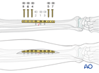 Simple transverse tibial shaft fracture: ORIF - Compression plating