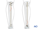 Tibial shaft intact wedge fracture: Intramedullary nailing