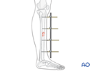 Tibial shaft fragmentary wedge fracture: Uniplanar external fixator