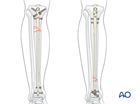 Tibial shaft fragmentary wedge fracture: Intramedullary nailing
