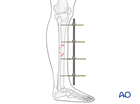 Tibial shaft intact segmental fracture: Uniplanar external fixator