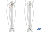 Tibial shaft intact segmental fracture: Intramedullary nailing