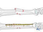 Tibial shaft intact segmental fracture: Bridge plating