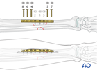 Tibial shaft intact segmental fracture: ORIF compression plating