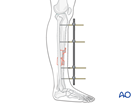 Tibial shaft multifragmentary fracture, fragmentary segmental: Uniplanar external fixator