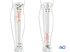 Tibial shaft multifragmentary fracture, fragmentary segmental: Intramedullary nailing