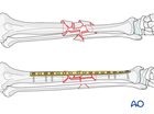 Tibial shaft multifragmentary fracture, fragmentary segmental: Bridge plating