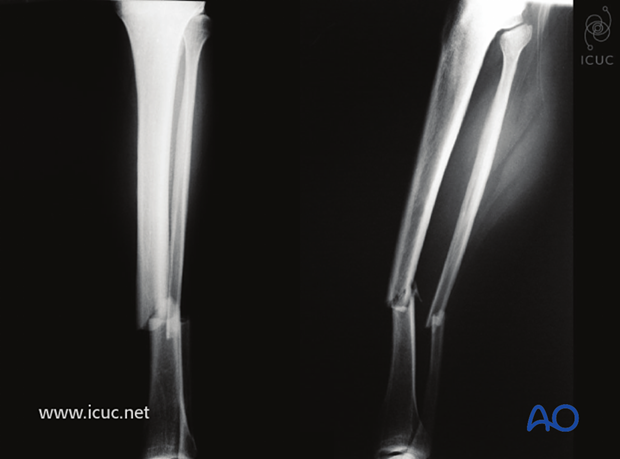 Preoperative AP and lateral images of closed, fragmentary distal tibial shaft fracture