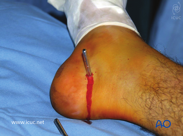 Pre-reduction pins are placed in the calcaneus and the posterior proximal tibia for the use of a femoral fixator on the medial side of the lower leg.