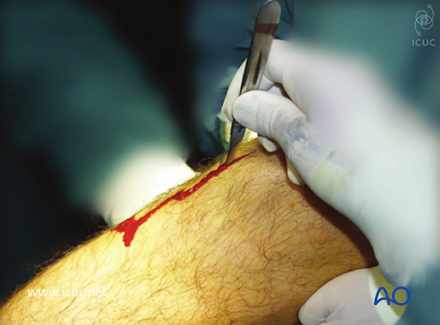 Incision over the patellar tendon to obtain access to the entry point