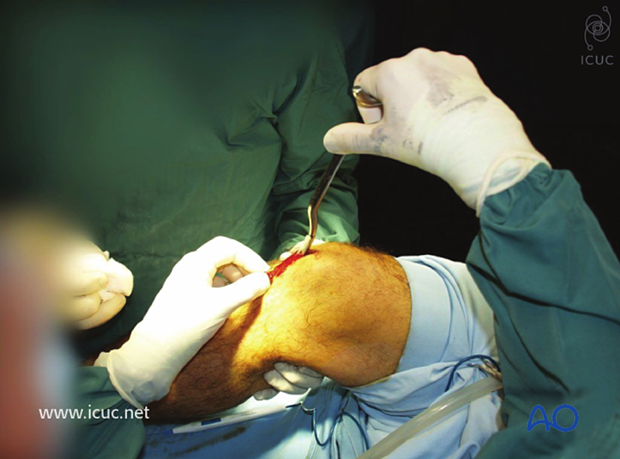 Once the insertion site is chosen the tibial awl is inserted to open the canal.