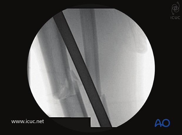 This image shows the tibia is well reduced with the use of the distracting external fixator.