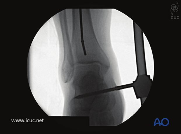The ball-tipped guide wire is positioned in the middle of the distal tibia, touching the subchondral line.