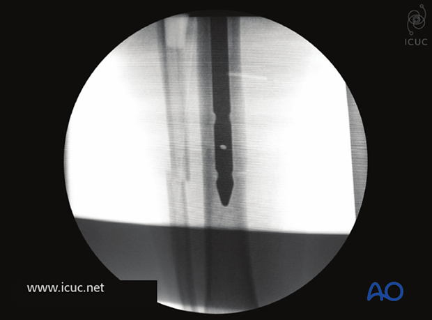 In this patient, the tibial canal was very narrow and so a small non-cannulated nail was used.