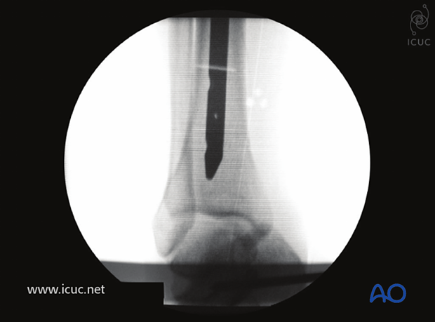 The nail is inserted into the tibia so that the tip rests just above the subchondral line.