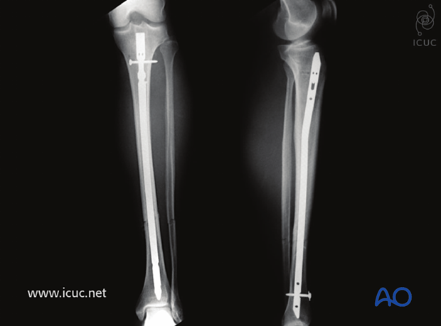 AP lateral images with excellent reduction and dynamically locked tibial nail