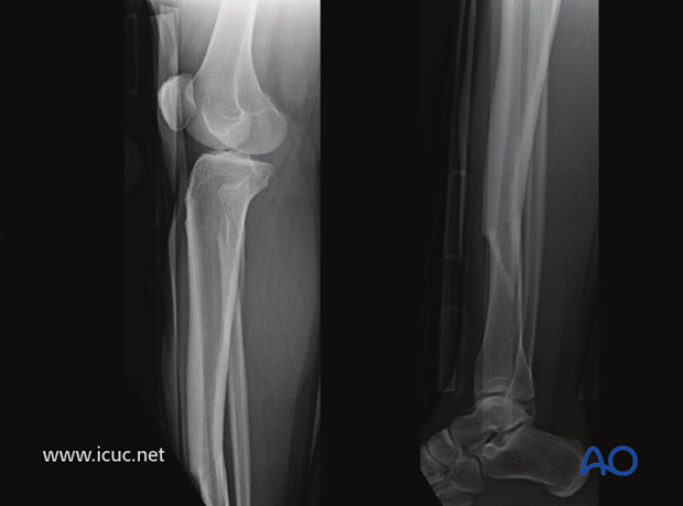 Lateral image of the same fracture.