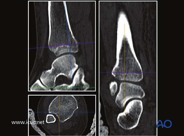 A CT scan at the malleolar level showed that the fracture did continue into the ankle joint but with minimal displacement.