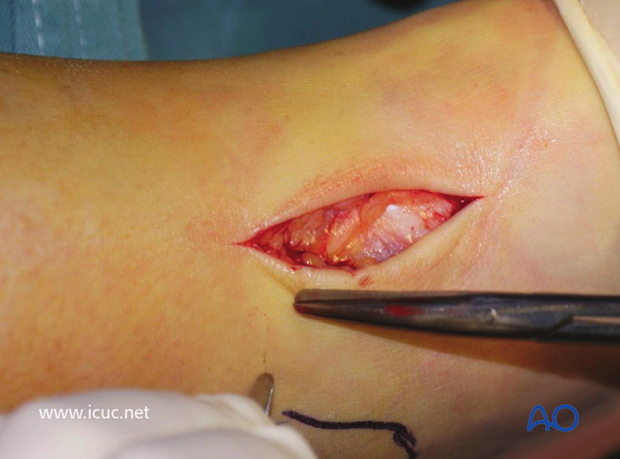 Before plating the tibia, a lag screw was placed across the fracture site just above the ankle to prevent the intraarticular component from displacing.