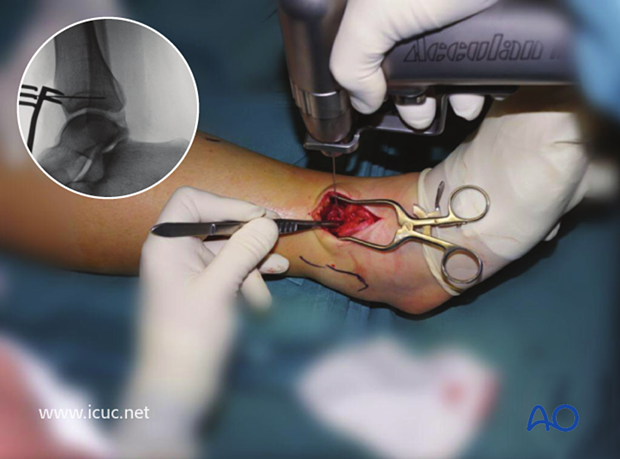 A K-wire was inserted to ensure the fracture did not displace during lag screw insertion.