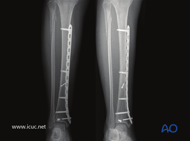 Healed tibial fracture at 6 months