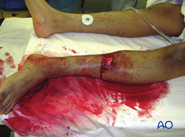 Ilizarov method of fixation for the management of pilon and distal tibial  fractures in the compromised diabetic patient: A technique guide.