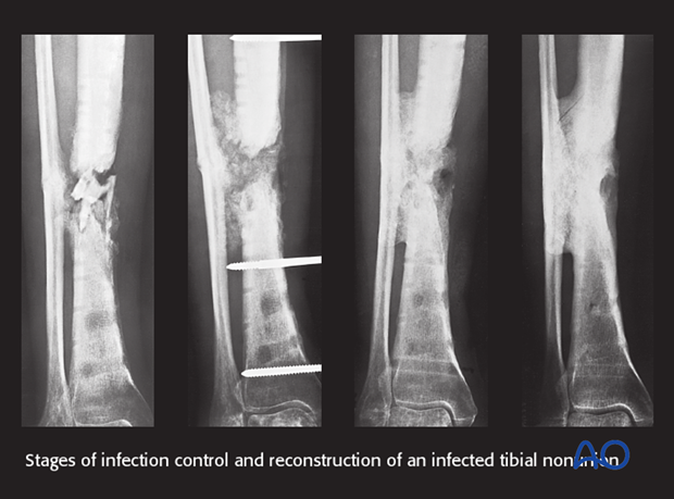 THE MANAGEMENT OF INFECTED NONUNION TIBIA SHAFT WITH ILIZAROV RING