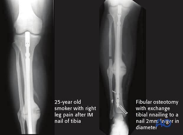 Patient with tibia nonunion. a X-ray from the pre-treatment period