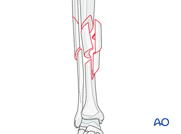 C1 type tibial shaft fracture