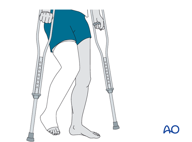 Broken Leg: If my tibial shaft fracture gets surgery, when can I