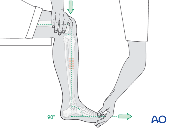 fracture management with limited resources