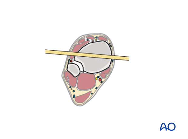 fracture management with limited resources